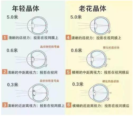 近視就不會老花了嗎？